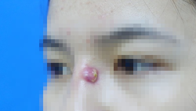 Các loại biến chứng nhiễm trùng do đặt sụn nhân tạo nâng mũi