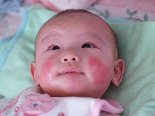 Giải thoát cho bé gái 9 tuổi bị bệnh chàm hành hạ suốt 5 năm liền Giải thoát cho bé gái 9 tuổi bị bệnh chàm hành hạ suốt 5 năm liền