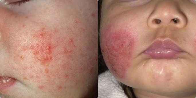Giải thoát cho bé gái 9 tuổi bị bệnh chàm hành hạ suốt 5 năm liền Giải thoát cho bé gái 9 tuổi bị bệnh chàm hành hạ suốt 5 năm liền