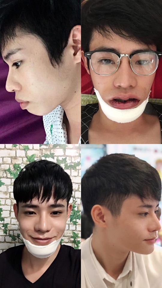 Chàng trai Hà Tĩnh 4 lần giấu gia đình phẫu thuật thẩm mỹ Chàng trai Hà Tĩnh 4 lần giấu gia đình phẫu thuật thẩm mỹ