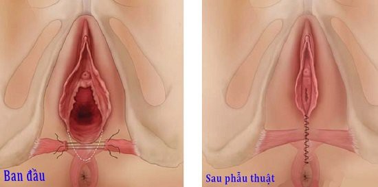 Người phụ nữ bị chảy máu, mưng mủ sau thẩm mỹ vùng kín Người phụ nữ bị chảy máu, mưng mủ sau thẩm mỹ vùng kín