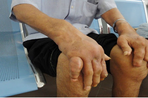 Chế độ ăn cho người bệnh gout: Những điều quan trọng cần ghi nhớ Chế độ ăn cho người bệnh gout: Những điều quan trọng cần ghi nhớ