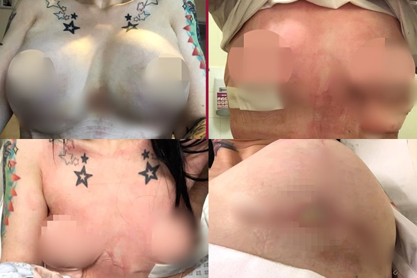 Chi tiền xuất ngoại nâng cấp vòng 1, cô gái đau đớn cắt bỏ 2 bên ngực vì nhiễm trùng 