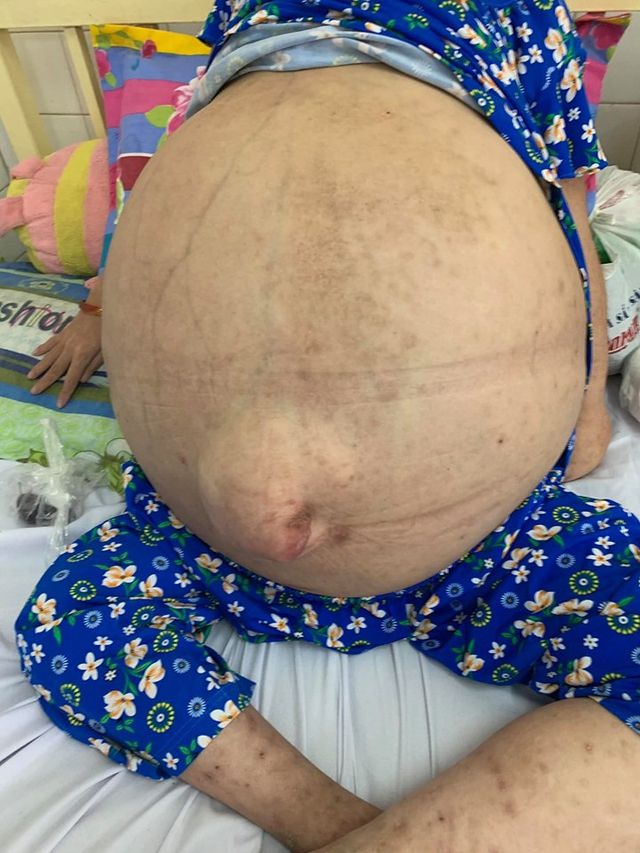 Cơ thể nhẹ tênh và đôi chân như muốn bay của cô gái từng mang khối u 'khủng' 50kg Cơ thể nhẹ tênh và đôi chân như muốn bay của cô gái từng mang khối u 'khủng' 50kg
