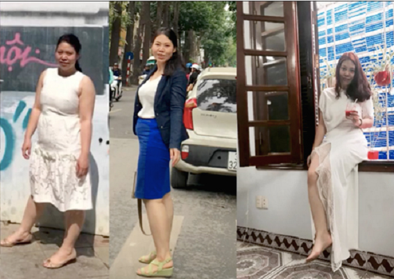 Quá trình giảm cân thần kỳ nhờ phẫu thuật thu nhỏ dạ dày của cô gái trẻ