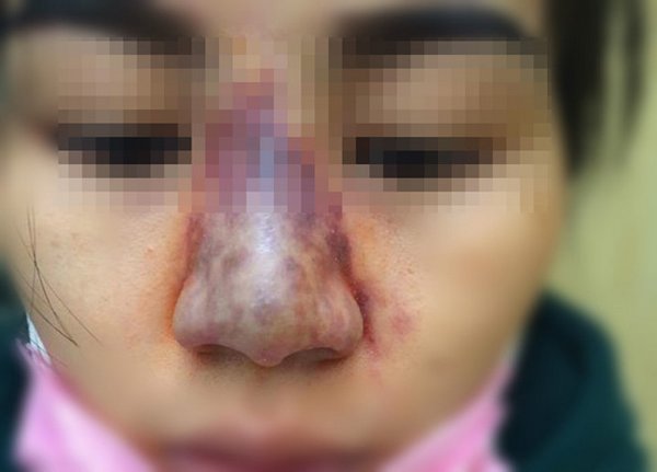 Có nên nâng mũi bằng tiêm filler? Có nên nâng mũi bằng tiêm filler?