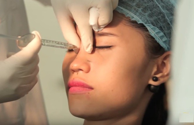 Có nên nâng mũi bằng tiêm filler? Có nên nâng mũi bằng tiêm filler?