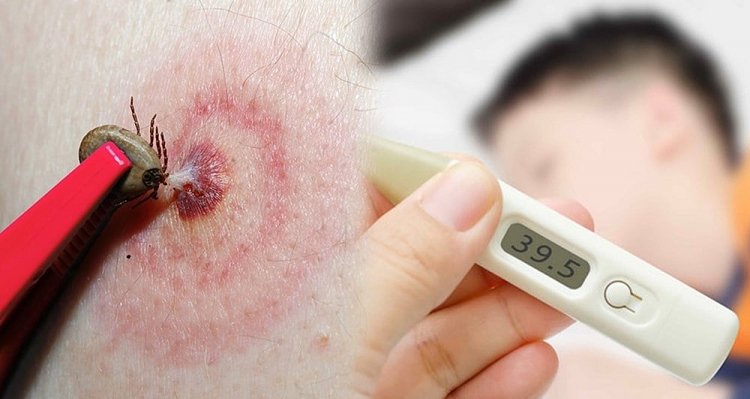 Con sốt cao hơn 10 ngày không khỏi, đưa đi khám mới phát hiện vết loét 