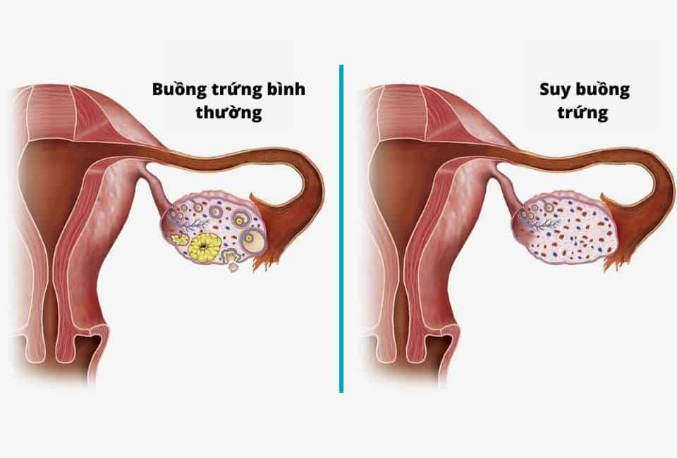 Dấu hiệu nhận biết suy buồng trứng sớm mà chị em dễ bỏ qua Dấu hiệu nhận biết suy buồng trứng sớm mà chị em dễ bỏ qua