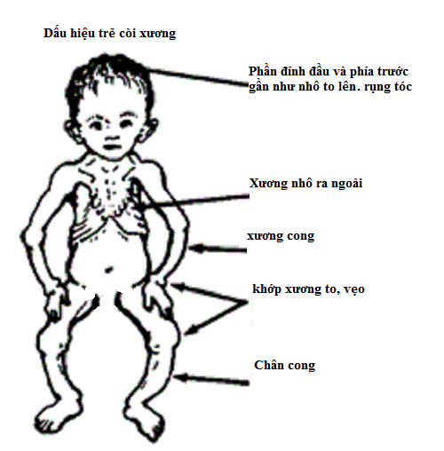 Trẻ còi xương: Dấu hiệu và những sai lầm chữa bệnh cha mẹ chớ coi thường