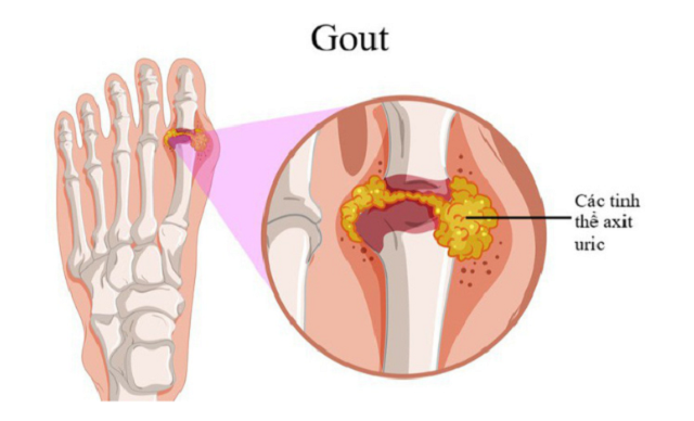 Bai-thuoc-chua-Gut-tu-dau-xanh Bai-thuoc-chua-Gut-tu-dau-xanh