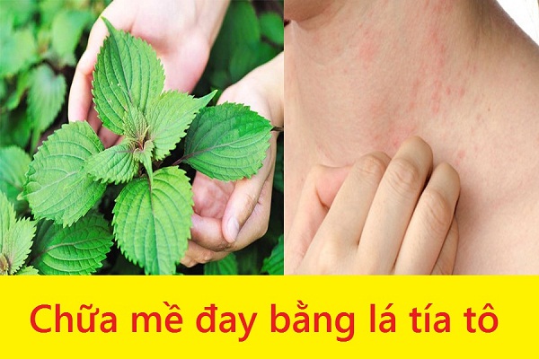 Benh-noi-me-day-khi-troi-lanh Benh-noi-me-day-khi-troi-lanh