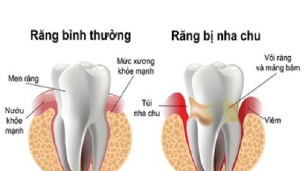 Chữa viêm lợi, sưng mộng răng, tụt chân răng bằng Thuốc Nam Chữa viêm lợi, sưng mộng răng, tụt chân răng bằng Thuốc Nam