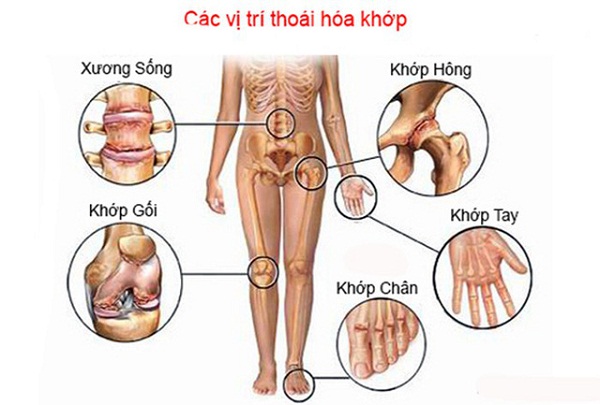Cu-ba-het-thoai-hoa-khop-chi-sau-3-thang-thuoc Cu-ba-het-thoai-hoa-khop-chi-sau-3-thang-thuoc