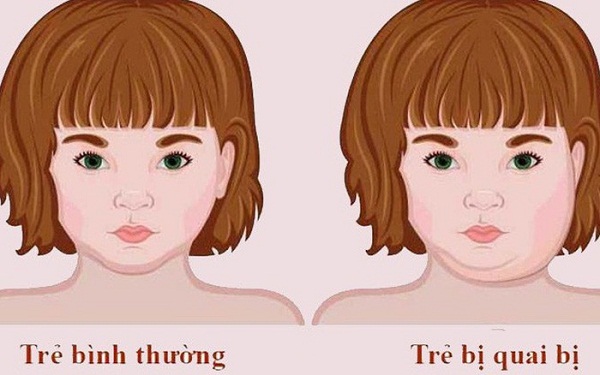 Dieu-tri-quai-bi-bang-Dong-Y Dieu-tri-quai-bi-bang-Dong-Y