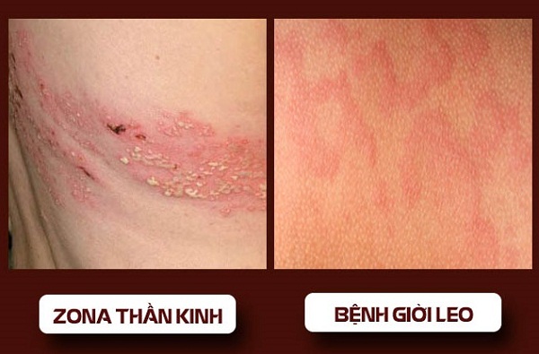 Dong-y-tri-benh-gioi-leo