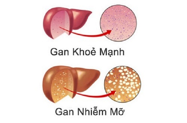 Khoi-han-men-gan-cao-va-mo-mau-suot-14-nam-chi-sau-1-thang-uong-Thuoc-Nam