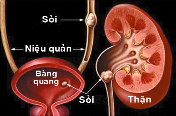 Tac-dung-cua-kim-tien-thao-dieu-tri-soi-va-tiet-nieu