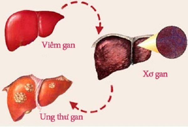 Thuoc-Nam-chua-benh-gan