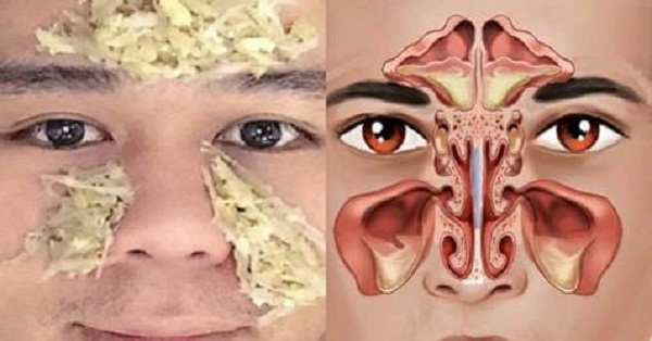 5 liệu pháp điều trị viêm xoang hiệu quả theo Đông y