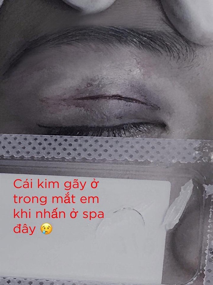 Bác sĩ 'mò' kim trong mí mắt, cứu cô gái suýt mù lòa vì nhấn mí giá rẻ ở spa Bác sĩ 'mò' kim trong mí mắt, cứu cô gái suýt mù lòa vì nhấn mí giá rẻ ở spa