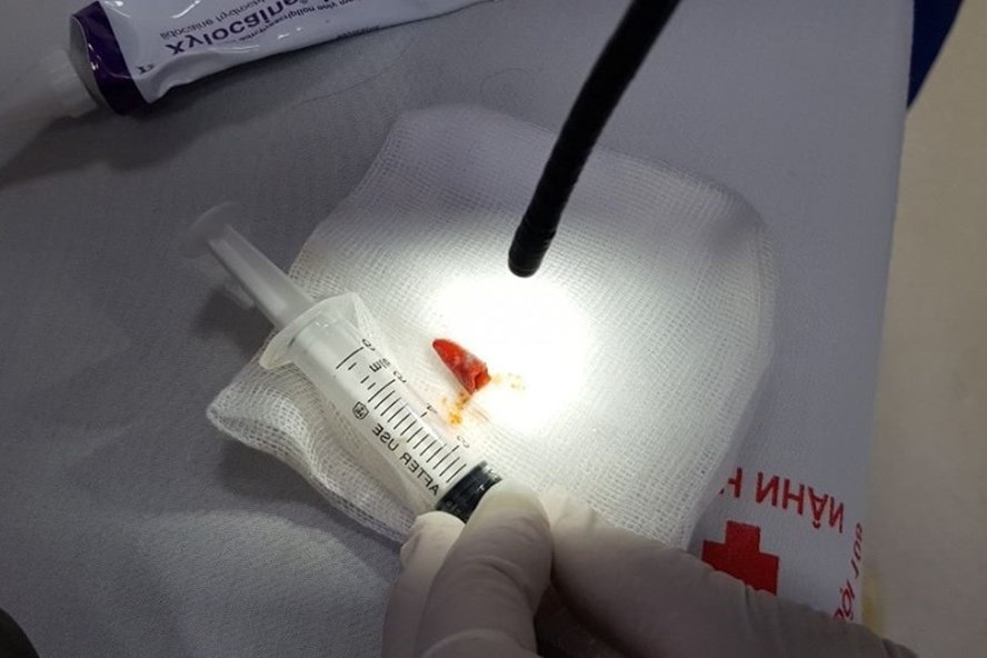 Ho khù khụ suốt 2 tháng vì miếng ớt kẹt trong đường thở