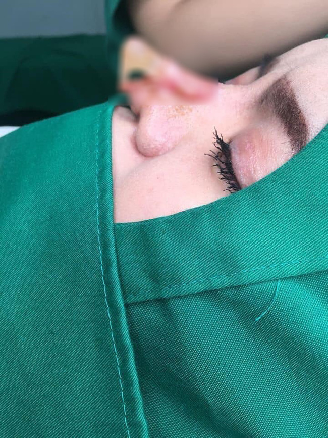 Hoảng sợ trước loạt ảnh nâng mũi hỏng của cô gái trẻ, nhiều chị em nên cân nhắc trước khi thẩm mỹ