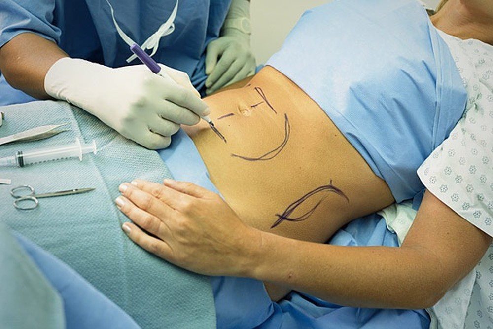 Đừng mất mạng vì hút mỡ bụng: Những điều quan trọng cần lưu ý