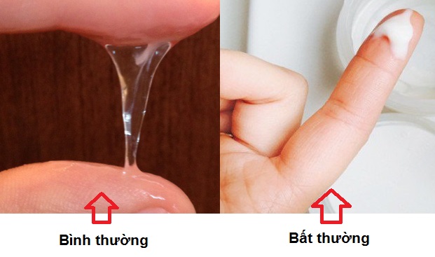 Dấu hiệu khí hư bất thường và bất thường