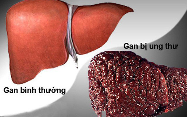 Kinh nghiệm chiến thắng ung thư [8]: Món ăn đặc biệt giúp cụ ông U70 thoát án tử bệnh ung thư gan