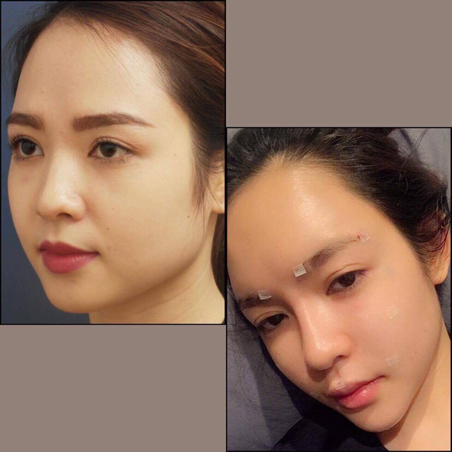 Cô gái phải rạch mặt để nặn mủ sau bơm mỡ từ bụng lên mặt: Lưu ý gì khi làm đẹp bằng tiêm mỡ tự thân Cô gái phải rạch mặt để nặn mủ sau bơm mỡ từ bụng lên mặt: Lưu ý gì khi làm đẹp bằng tiêm mỡ tự thân
