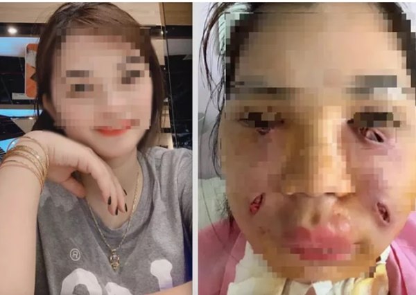 Cô gái phải rạch mặt để nặn mủ sau bơm mỡ từ bụng lên mặt: Lưu ý gì khi làm đẹp bằng tiêm mỡ tự thân Cô gái phải rạch mặt để nặn mủ sau bơm mỡ từ bụng lên mặt: Lưu ý gì khi làm đẹp bằng tiêm mỡ tự thân