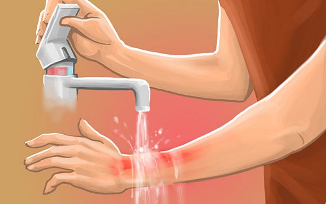 Làm gì khi bị bỏng để không gây bỏng rát và để lại sẹo xấu Làm gì khi bị bỏng để không gây bỏng rát và để lại sẹo xấu