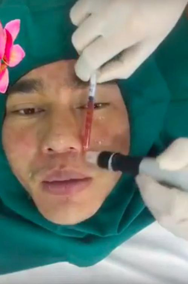 Lê Dương Bảo Lâm phẫu thuật thẩm mỹ 100% mặt mà không bị đơ