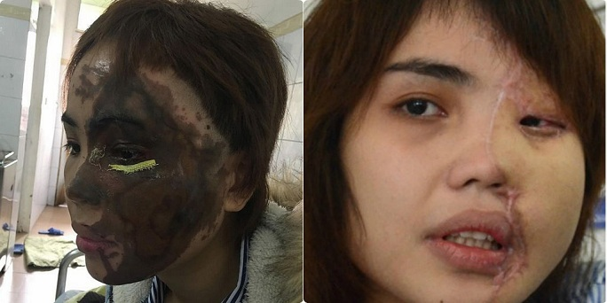 Hành trình tái tạo gương mặt cho cô gái bị chồng sắp cưới tạt axit Hành trình tái tạo gương mặt cho cô gái bị chồng sắp cưới tạt axit