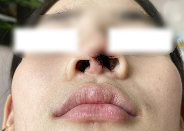 Lỗ mũi thiếu nữ 16 tuổi biến dạng sau khi thẩm mỹ tại spa gần nhà