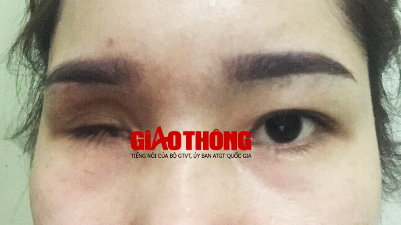 Cô gái Bắc Giang mù vĩnh viễn mù một bên mắt vì nâng mũi bằng tiêm filler Cô gái Bắc Giang mù vĩnh viễn mù một bên mắt vì nâng mũi bằng tiêm filler