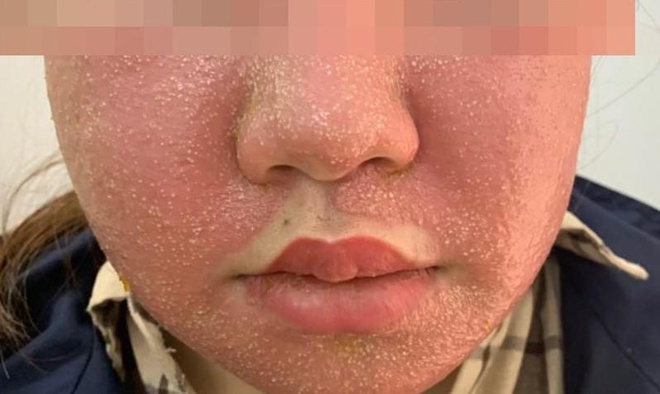 Mua mặt nạ trắng da trên mạng, cô gái 21 tuổi nhập viện vì mặt sưng vù, nổi mụn mủ
