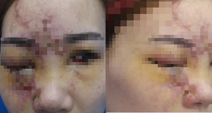 Vụ cô gái nâng mũi bị mù mắt: Những biến chứng kinh hoàng do nâng mũi bằng tiêm filler Vụ cô gái nâng mũi bị mù mắt: Những biến chứng kinh hoàng do nâng mũi bằng tiêm filler