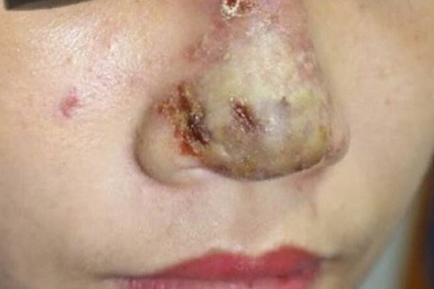 Vụ cô gái nâng mũi bị mù mắt: Những biến chứng kinh hoàng do nâng mũi bằng tiêm filler Vụ cô gái nâng mũi bị mù mắt: Những biến chứng kinh hoàng do nâng mũi bằng tiêm filler