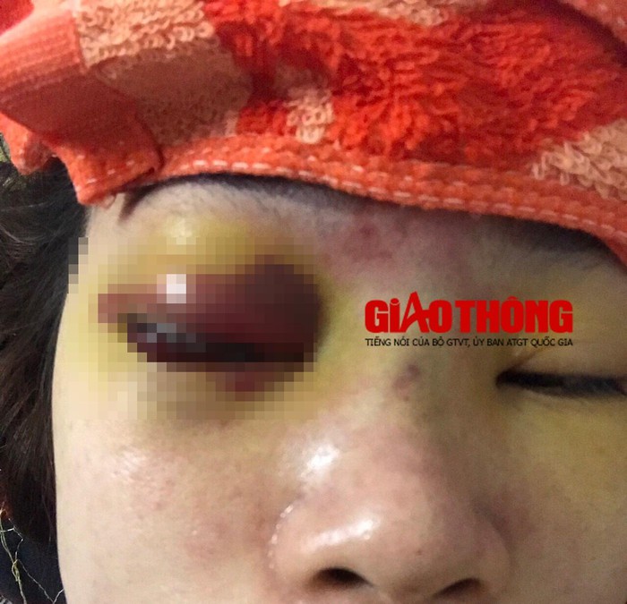 nâng mũi bị mù mắt