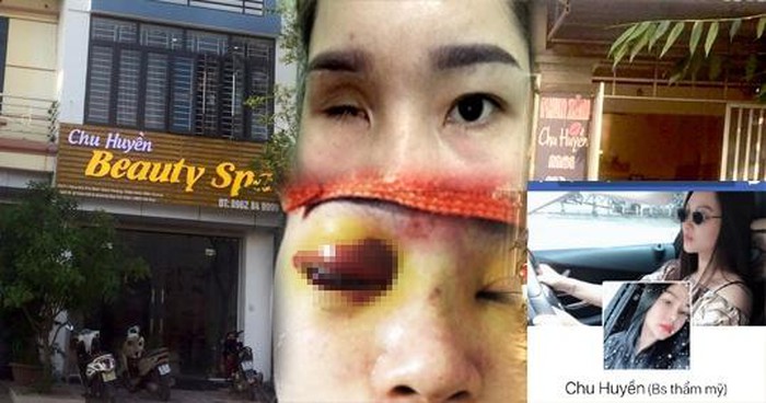 nâng mũi bị mù mắt