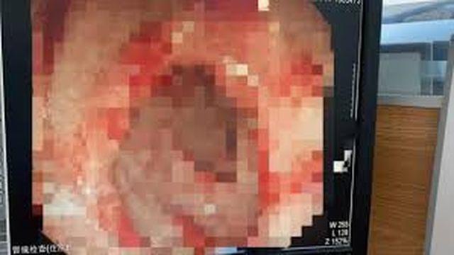 Người đàn ông nhập viện nguy kịch vì uống nhiều rượu để diệt virus corona