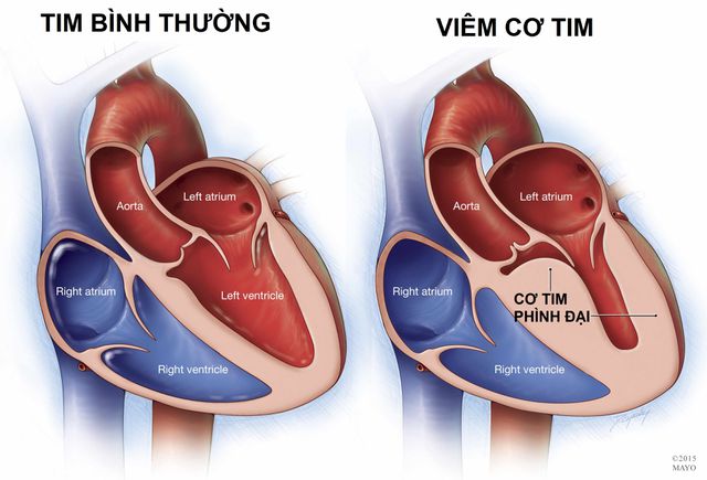 Viêm cơ tim: Nguyên nhân, biểu hiện và biến chứng nguy hiểm