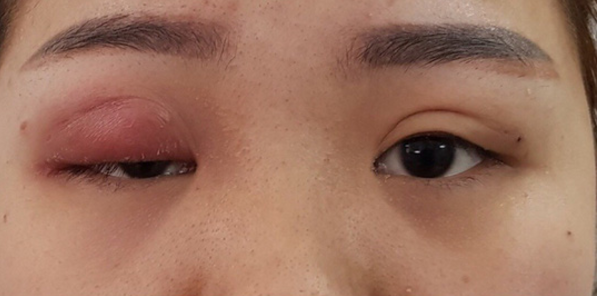 Những ca nhấn mí hỏng khiến chị em vỡ mộng đôi mắt to đẹp long lanh