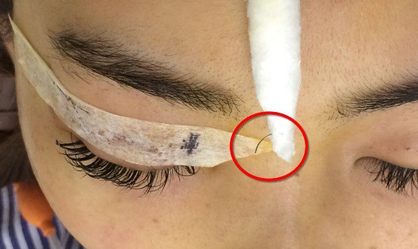 Những ca nhấn mí hỏng khiến chị em vỡ mộng đôi mắt to đẹp long lanh