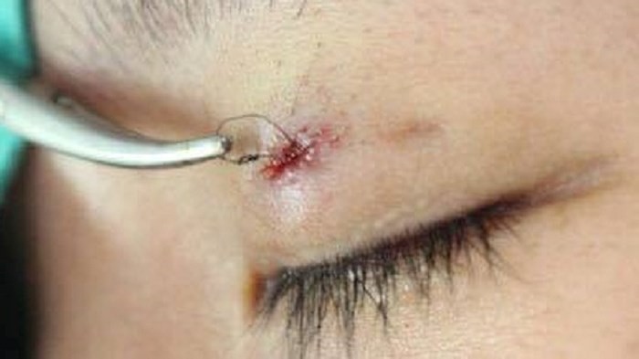 Những ca nhấn mí hỏng khiến chị em vỡ mộng đôi mắt to đẹp long lanh