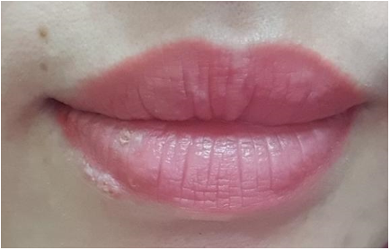 Nhiễm virus Herpes simplex do phun môi 