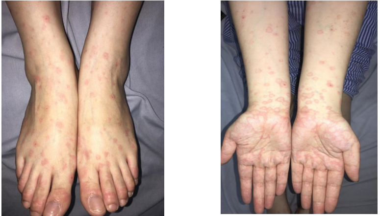 Nhiễm virus Herpes simplex do phun môi 