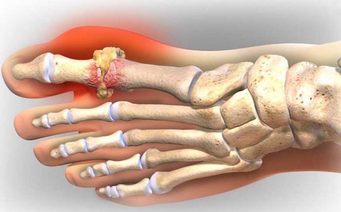 Sự lặng đọng urat gây tổn thương các khớp
